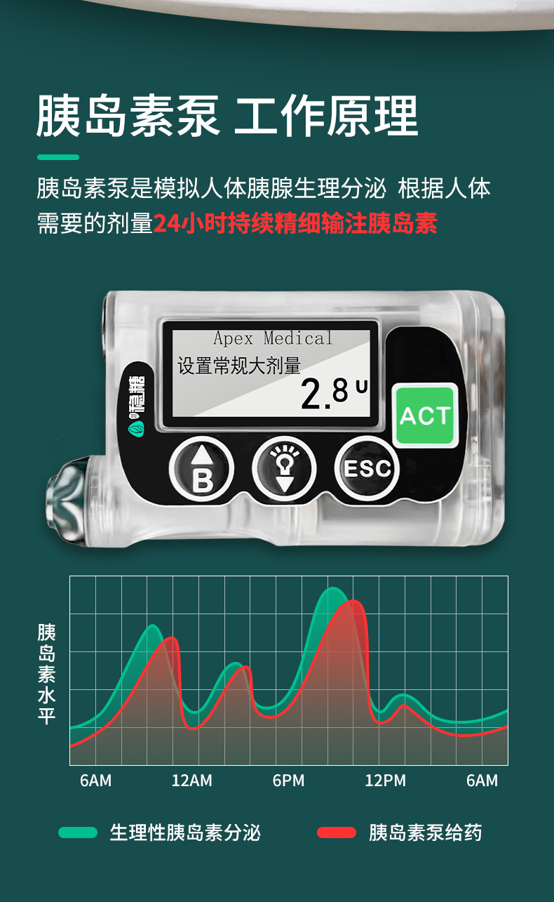 最新全自動(dòng)胰島素泵，糖尿病管理的革命性進(jìn)步，全自動(dòng)胰島素泵，糖尿病管理的突破性革新