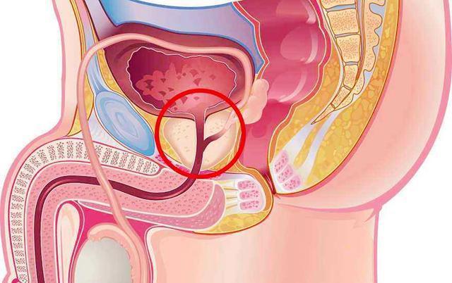 男性前列腺肥大，了解、識(shí)別與應(yīng)對(duì)，男性前列腺肥大，全面解析與應(yīng)對(duì)之道
